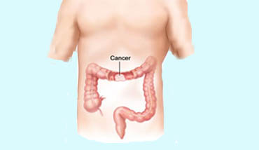 Colon cancer screening in Ranchi
