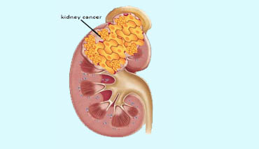 kidney cancer operation in Ranchi