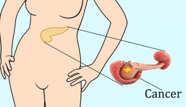 Pancreatic Cancer Surgery in Ranchi