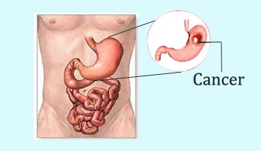 Stomach cancer operation